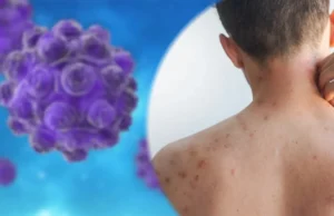 Casos de sarampión en Nuevo León se quintuplican en 2026