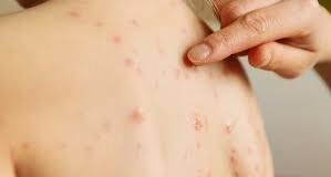 Primer caso local de sarampión en niño de Nuevo León