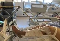 Fractura expuesta deja a panadero de 61 años hospitalizado en Monterrey
