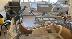Fractura expuesta deja a panadero de 61 años hospitalizado en Monterrey